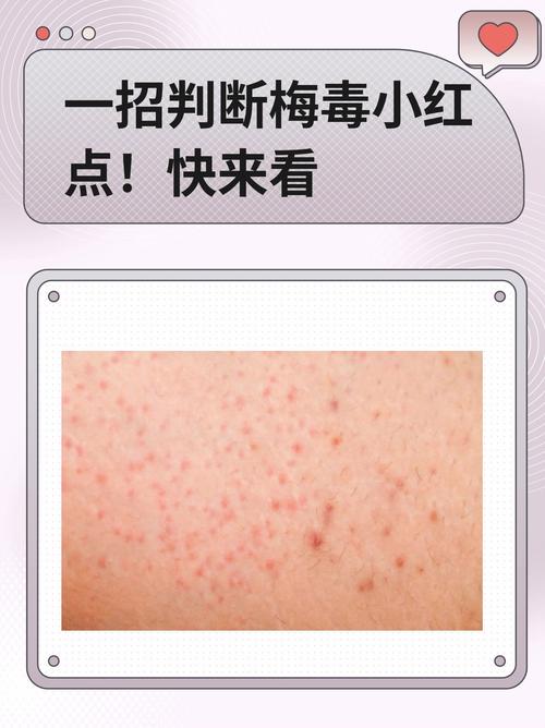 梅毒早期小红点症状图片对比:如何通过皮肤变化识别感染迹象 梅毒早期小红点症状图片对比:如何通过皮肤变化识别感染迹象